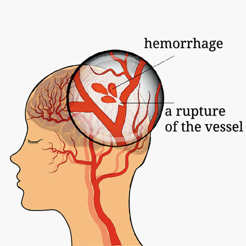 Treatment for Brain Hemorrhagic Stroke