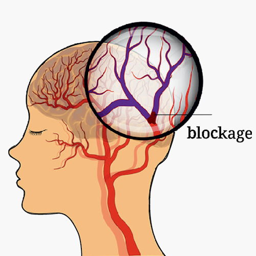 Treatment for Brain - Ischemic Stroke